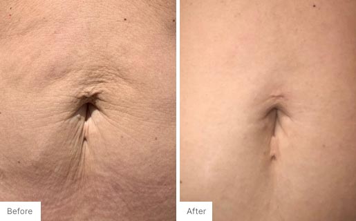 9 - Before and After Real Results photo of someone's belly button.