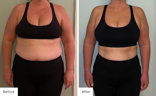 4 - Before and After of a woman's body using NeoraFit.
