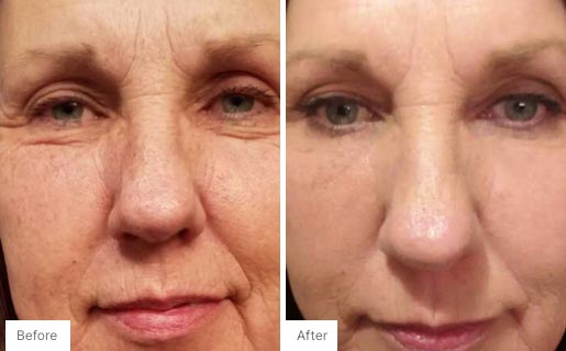 10 - Before and After Real Results image of a woman's face.